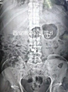 抗恶性肿瘤药,抗肿瘤药物有哪些