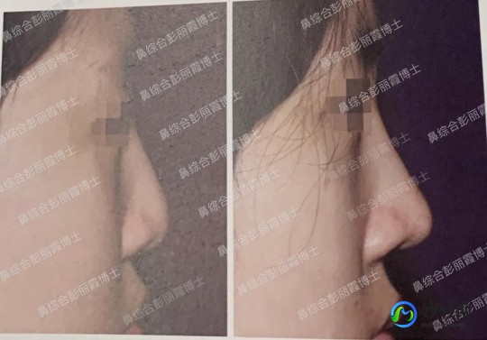 隆鼻什么材料好,隆鼻好的材料是什么