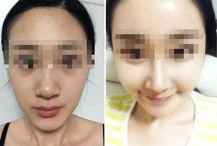 隆鼻什么材料好,隆鼻好的材料是什么