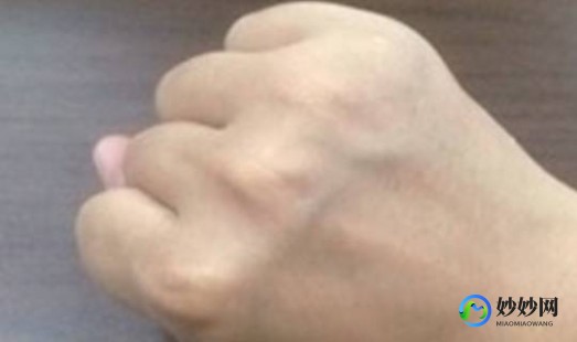 手上青筋明显,手上的青筋是什么