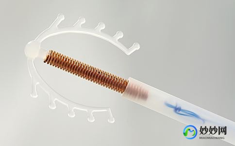 取环什么时候取最好,摘节育环的最佳时间