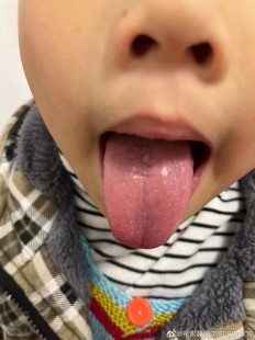腺样体肥大的孩子必须做手术吗,腺样体肥大的孩子必须做手术吗