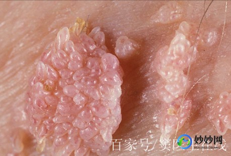 尖锐湿尤是怎么引起的,尖锐湿疣怎么得的