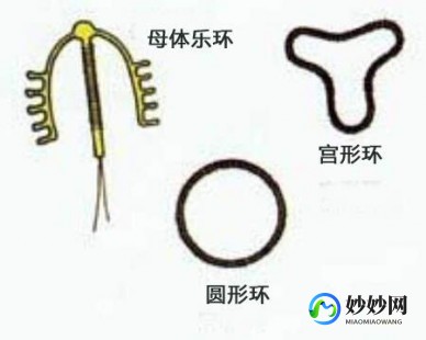 放环,女人上环,环有几种图形