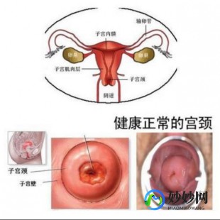 怎么排除是不是宫颈癌,怎么排除是不是宫颈癌