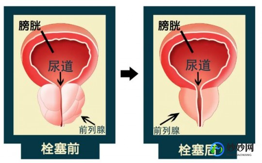 前列腺增生伴结石,前列腺增生伴结石是什么意思