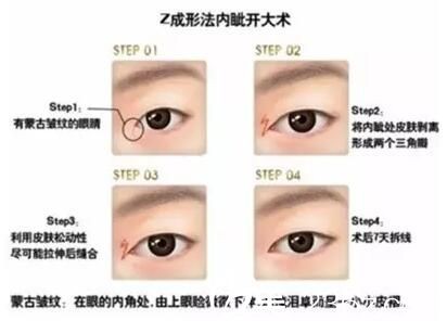 开内眼角效果,开内眼角有什么效果
