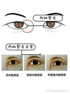 开内眼角效果,开内眼角有什么效果