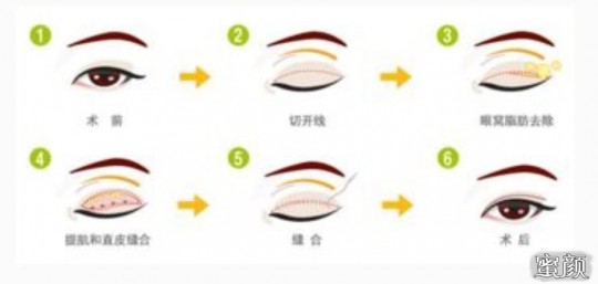 双眼皮手术后,做双眼皮后注意事项