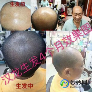 治秃顶生发,脱发严重怎么生发