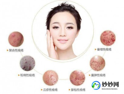 去痤疮,痤疮型痘痘怎么消除