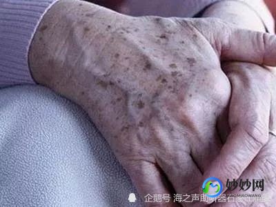 手上长老年斑的原因,手上出现老年斑是身体哪方面有问题