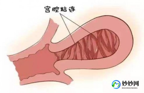 宫腔镜检查后,宫腔镜检查后需要休息几天