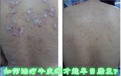 癣见康可以治什么,对门癣怎么才能根治
