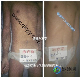 癣见康可以治什么,对门癣怎么才能根治