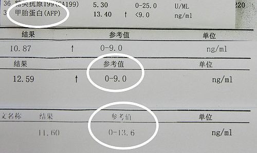 甲胎蛋白正常值,甲胎蛋白正常值范围