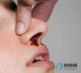 流鼻血怎么处理,流鼻血怎么治疗