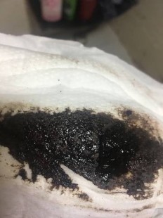 月经 黑色,月经来了是黑色的怎么回事