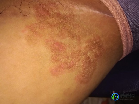 大腿根内侧红斑瘙痒,大腿内侧红色斑块瘙痒