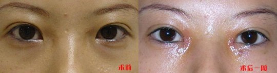 眼角提升手术,眼角提升手术前后图片效果
