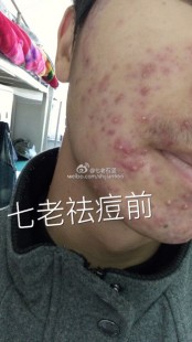 弟弟上面长痘痘,上长了好多痘痘