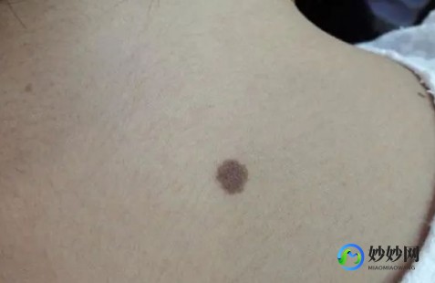 皮肤癌症状,皮肤癌症状
