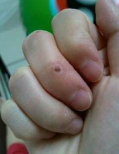 瘊子是什么,身体上长瘊子什么原因