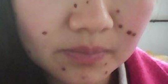 去痦子的方法,痦子怎么去掉