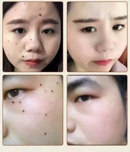 去痦子的方法,痦子怎么去掉