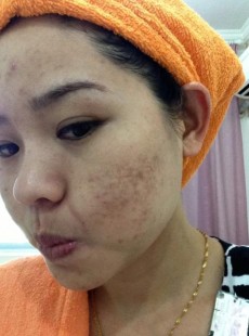 痘坑怎么治,脸上很多痘坑怎么处理