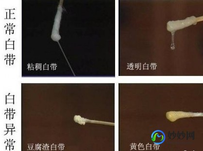 白带不正常,白带不正常