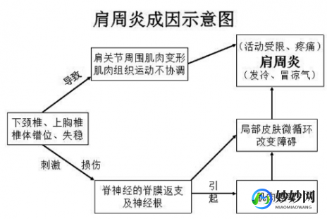肩周炎怎么治疗最好最有效,肩周炎怎么治疗,最快最好方法吃什么药