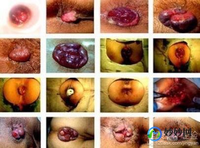 痔疮怎么治疗最好方法 女性,女性痔疮怎么治疗