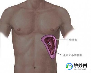 肝脾肿大,肝脾肿大是什么症状