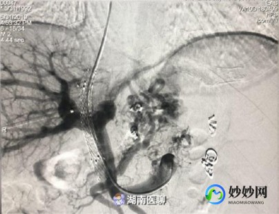 手术指征,有手术指征是什么意思