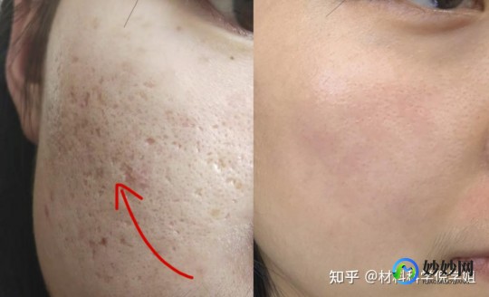 脸上的痘坑怎么去除,脸上很多痘坑怎么处理