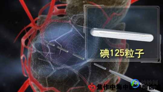 碘125,125碘粒子植入一定能控制肿瘤吗