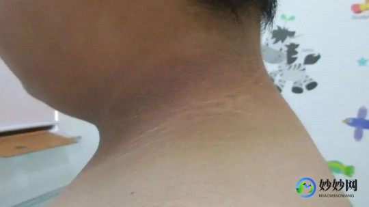 脸色暗沉发黑什么原因,皮肤暗沉发黑是什么原因