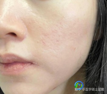 脸上痘坑怎么治疗,脸上很多痘坑怎么处理