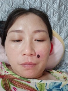 点痦子,痦子可以随便点掉吗
