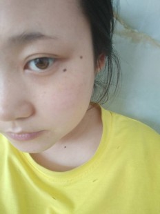 点痦子,痦子可以随便点掉吗