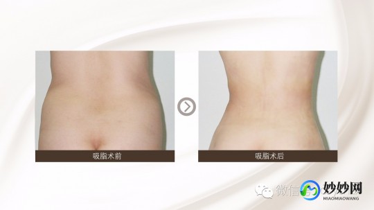 负压吸脂减肥,负压抽吸治疗怎么做