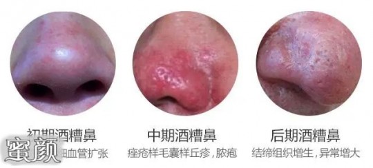 酒糟鼻会自愈吗,酒糟鼻会自愈吗