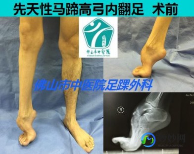 脚跟干裂的原因及治疗方法,脚后跟干裂