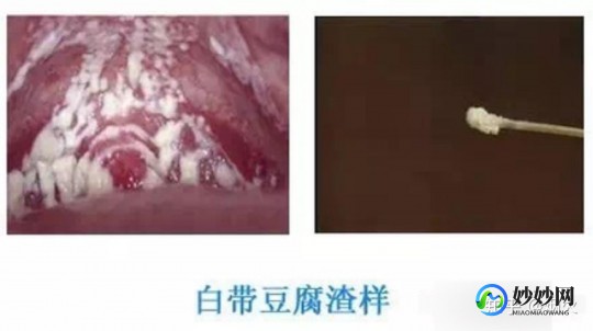 豆渣样白带,豆渣样的白带怎么回事