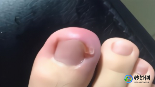 脚趾甲长肉,指甲里长出多余的肉