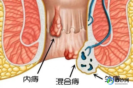 痔疮瘤,痔疮瘤必须手术吗