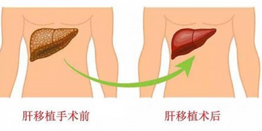 肝脏移植,肝移植是移植整个肝吗