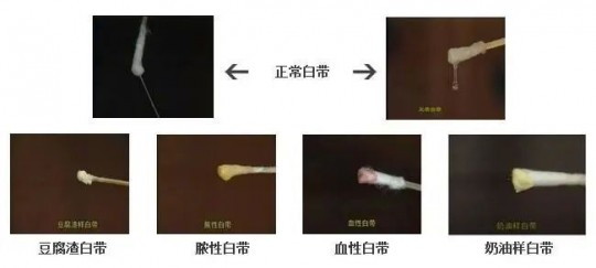 白带褐色有异味,白带褐色有味怎么回事