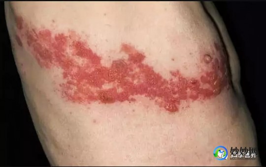 缠腰龙疱疹怎么治疗,蛇缠腰带状疱疹怎么治疗